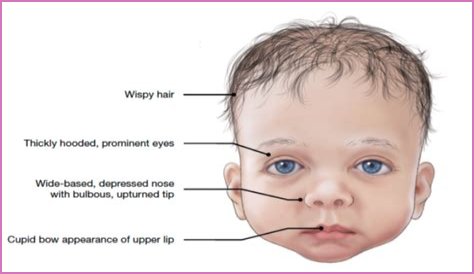 What does it mean when a baby has a protruding forehead?