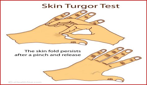What is skin turgor?